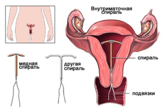 Как работи хормоналното вътрематочно устройство: плюсове и минуси на IUD според лекарите