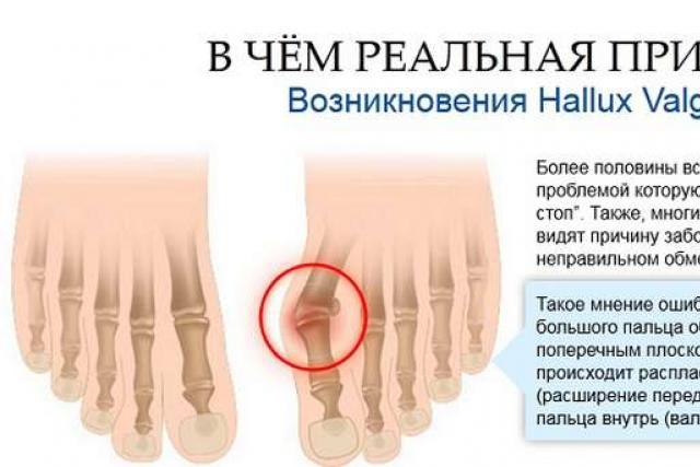 Лечение на буниони на големите пръсти на краката. Какво да правите, ако има буниони на пръстите на краката