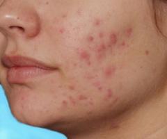 Acné sur les pommettes : causes et traitement Cause de l'acné interne sur les pommettes