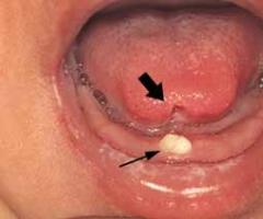 Dojenček ima belo piko na dlesni: kaj to pomeni, zakaj se je otroku pojavil mozolj, kako ga zdraviti?